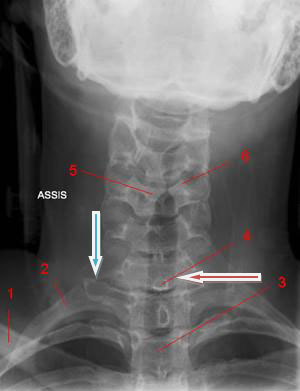 Cervical Spine X-Ray: Image 1