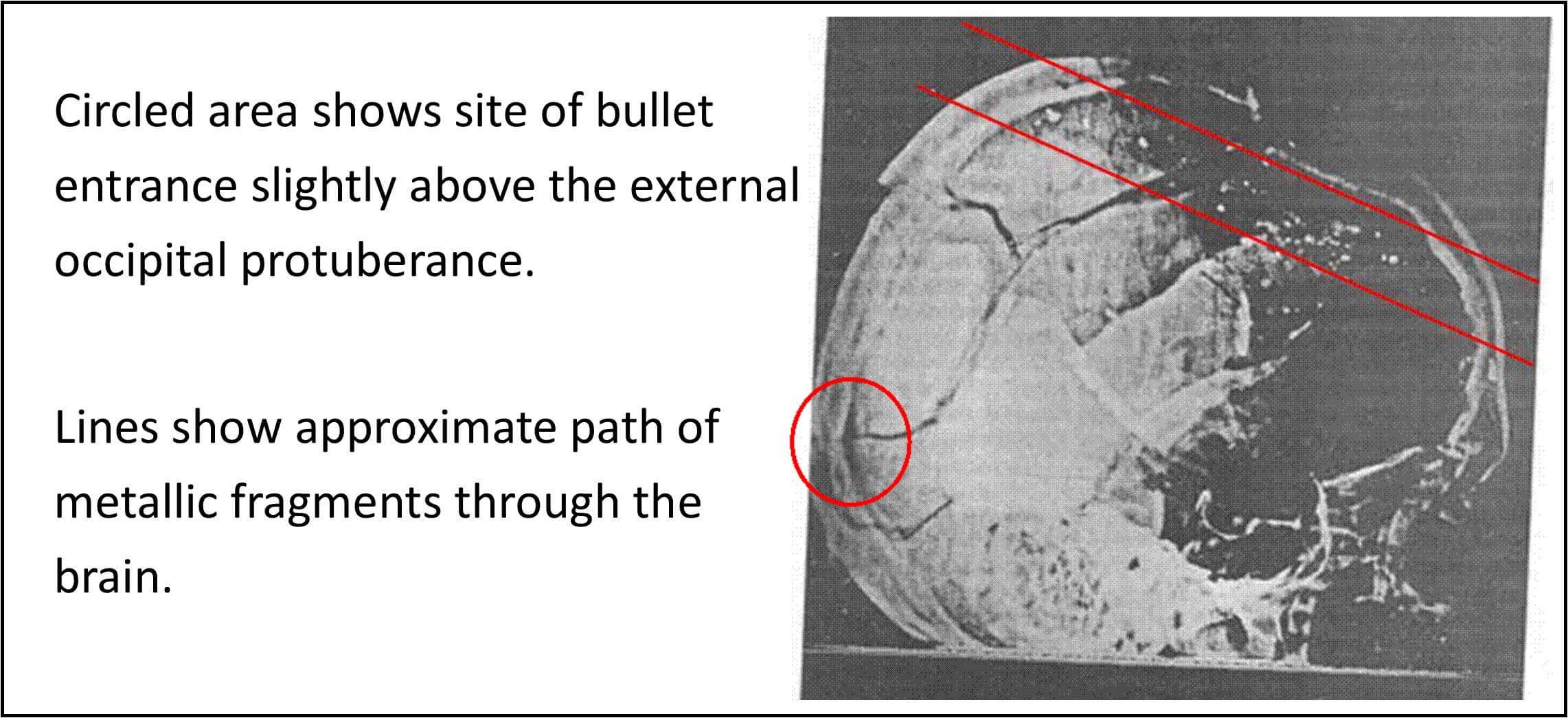 Annotated X ray