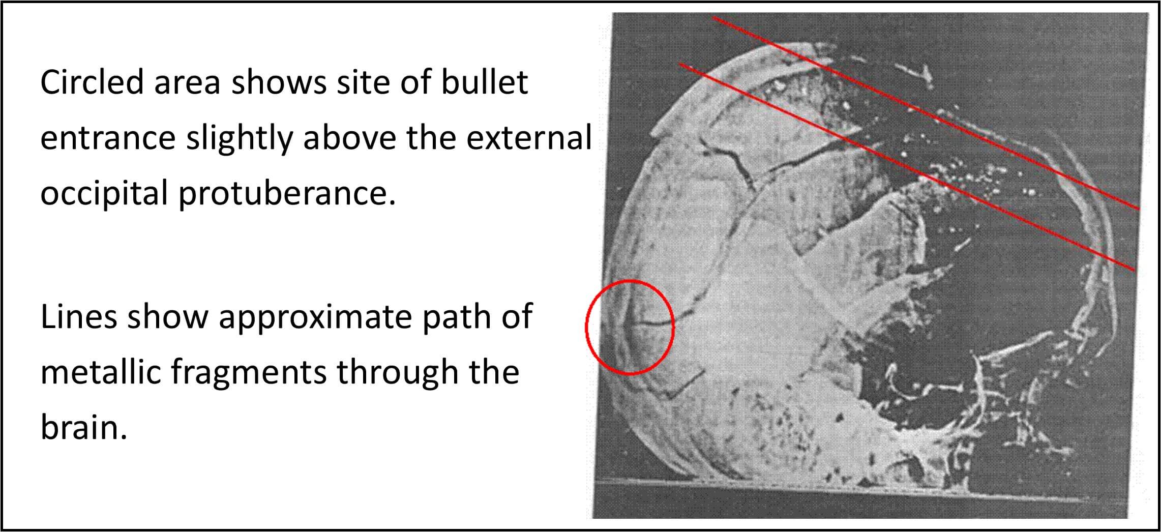 Annotated X ray