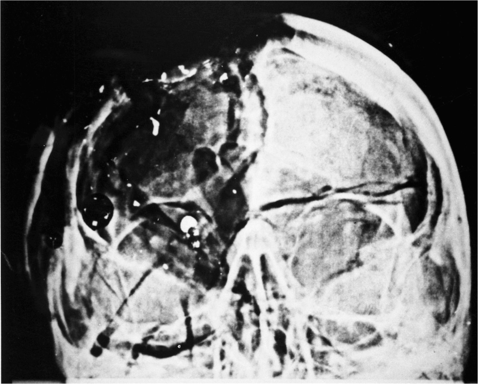 The State of Texas vs Lee Harvey Oswald: The JFK Autopsy Skull X-rays